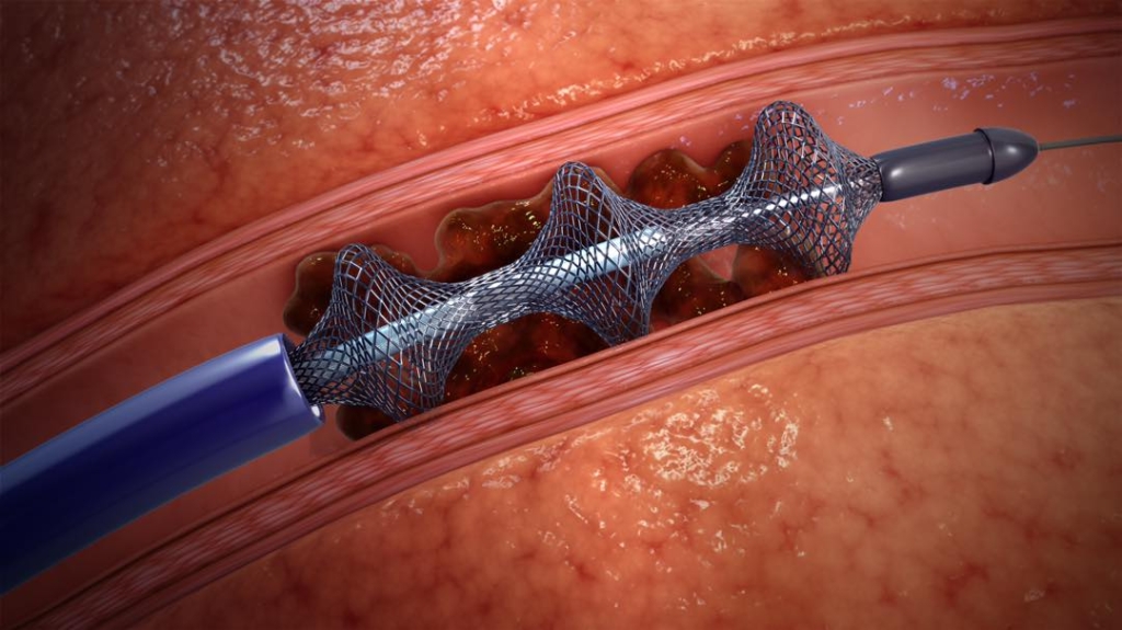 Animation of the FlowTriever Lifesaving Blood Clot Remover in action