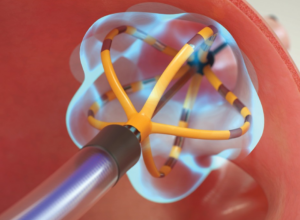 Huntington Health Performs First Pulsed Field Ablation in the San Gabriel Valley