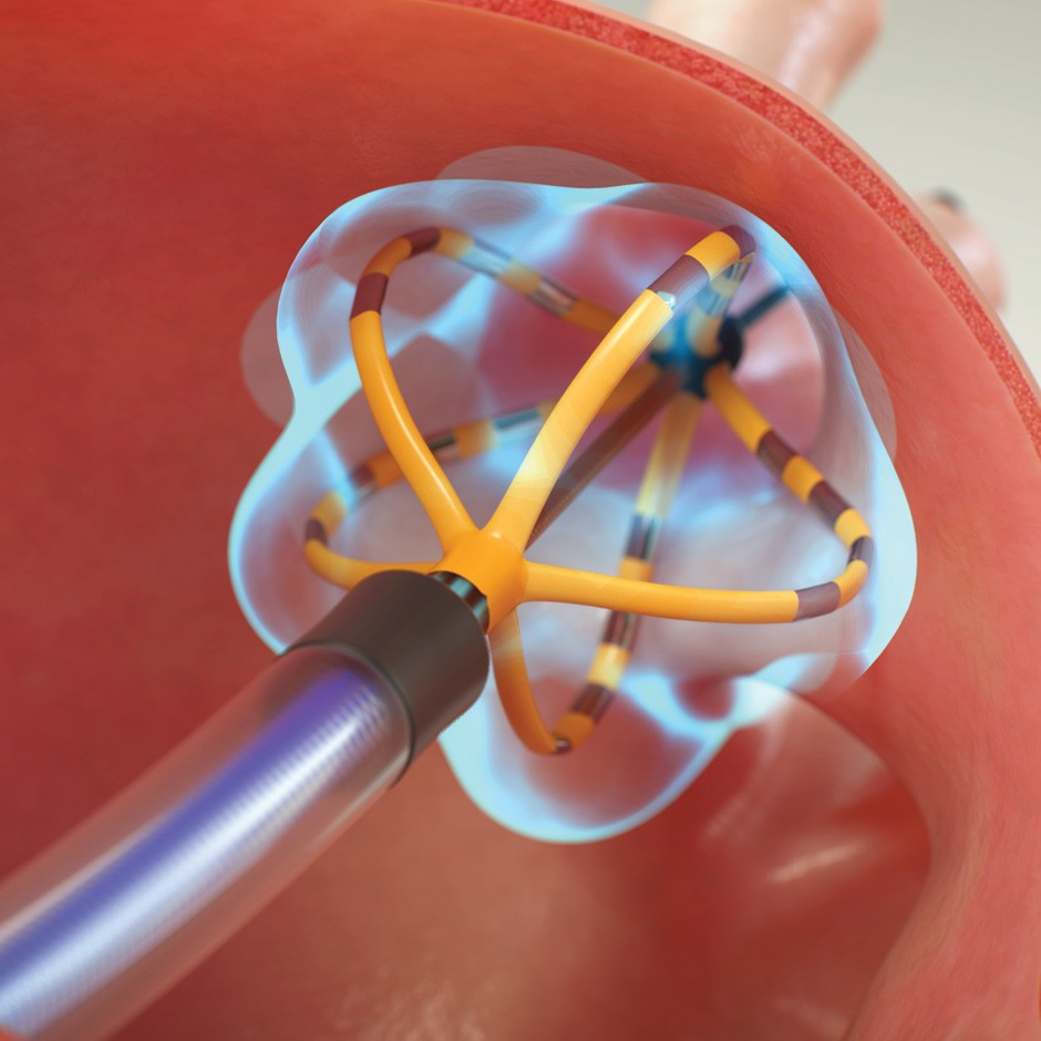 Huntington Health Performs First Pulsed Field Ablation in the San Gabriel Valley