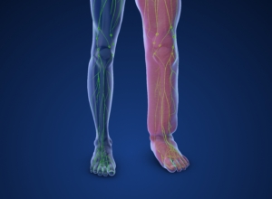 Lymphedema: What you need to know