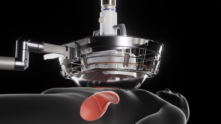 Huntington Cancer Center Introduces Breakthrough Noninvasive Treatment for Liver Tumors